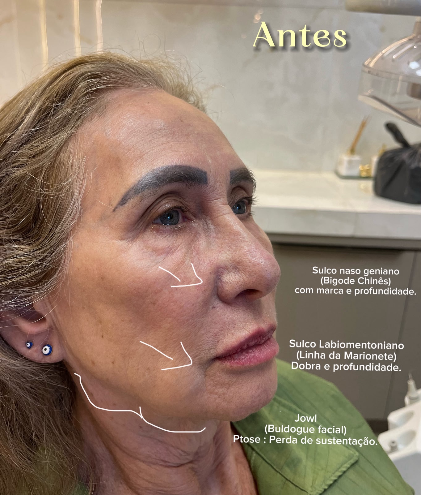 Harmonização Facial – Antes