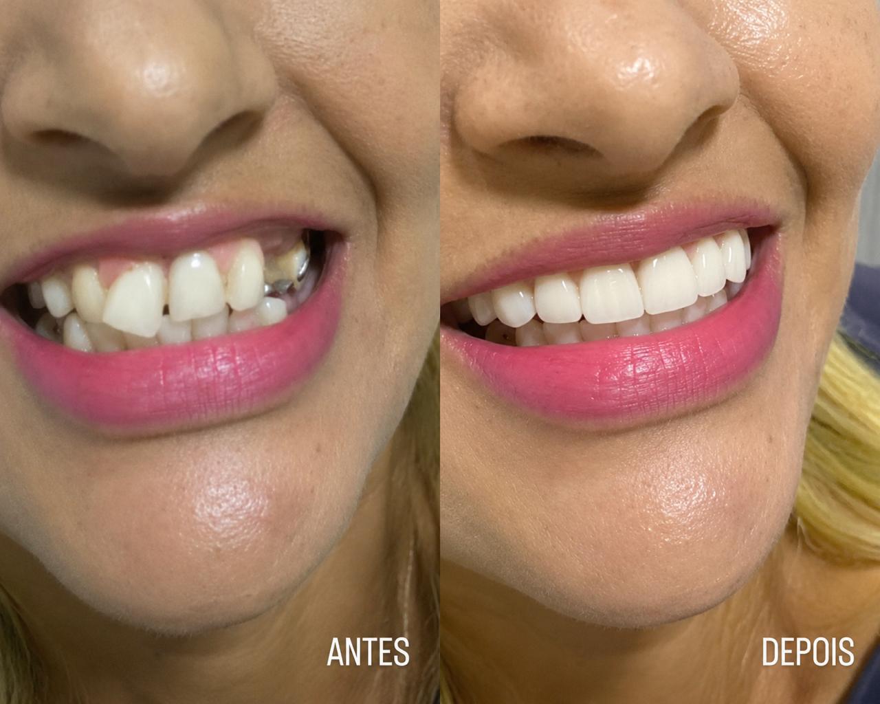 Transformação do sorriso – Antes e Depois