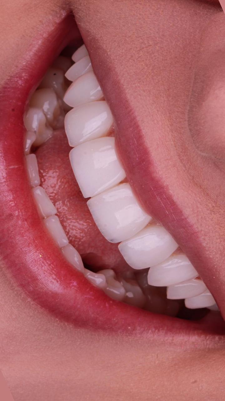 Lentes de Contato Dental