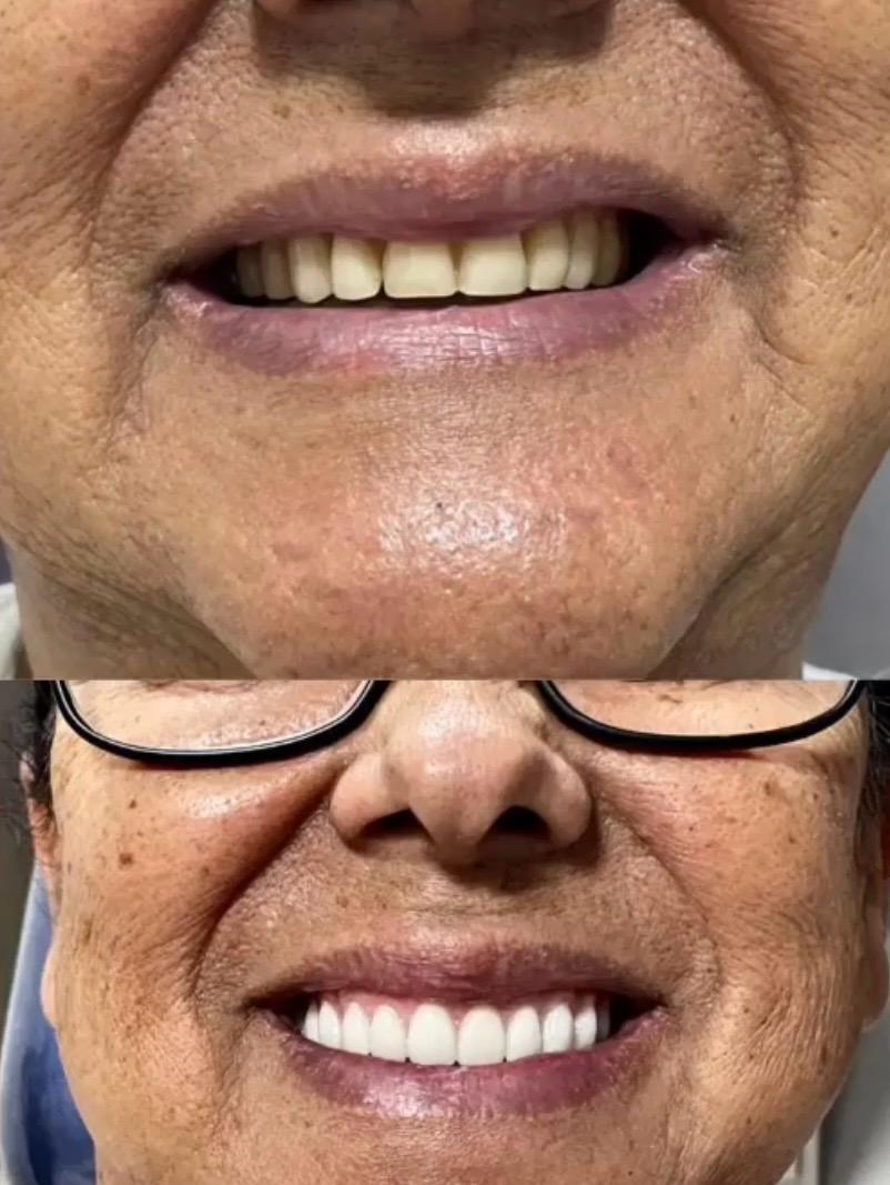 Prótese Dental – Antes e Depois